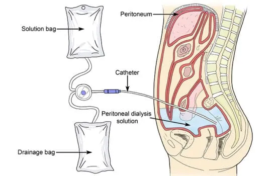 Continuous Ambulatory Peritoneal Dialysis In Nagpur