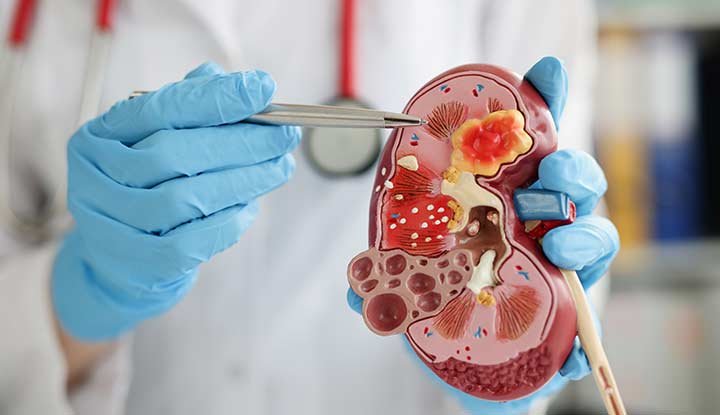 Kidney Failure Specialist In Nagpur