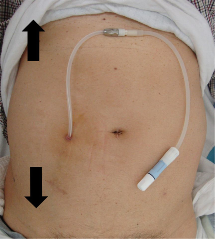 Peritoneal Dialysis In Nagpur