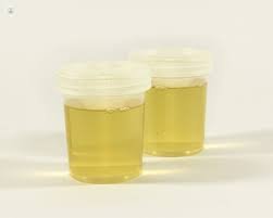 Proteinuria in urine