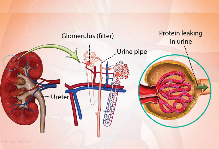 Nephrotic Syndrome