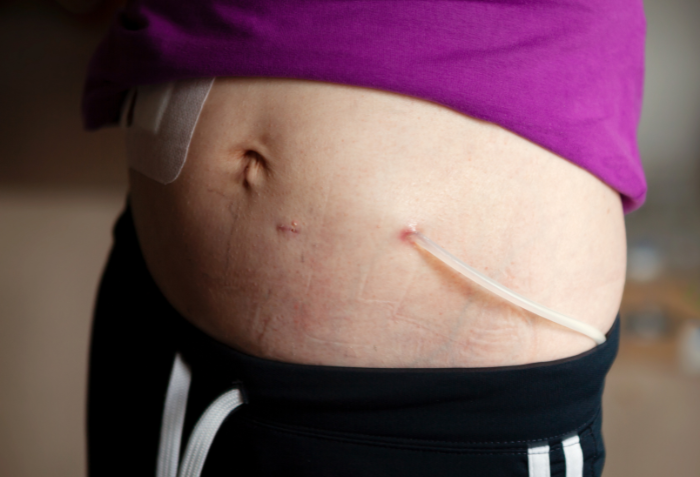 Peritoneal Dialysis