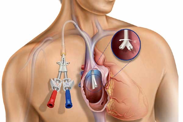 Dialysis