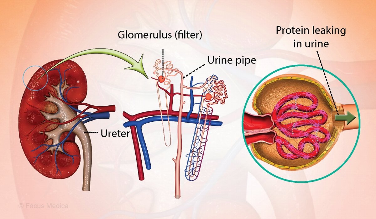 Nephrotic Syndrome