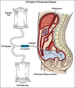 Continuous Ambulatory Peritoneal Dialysis In Nagpur