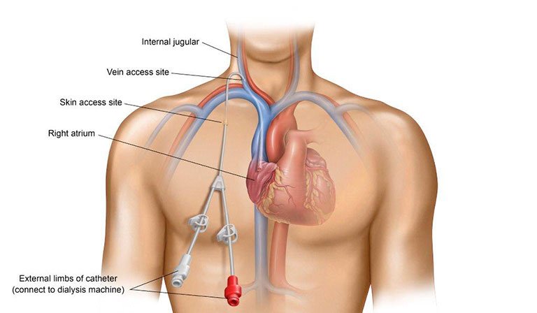 Dialysis catheter insertion in Nagpur