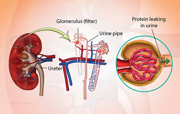 Nephrotic Syndrome Expert In Nagpur