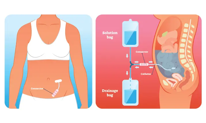 Peritoneal Dialysis In Nagpur
