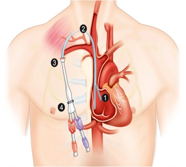 Permcath Insertion Dialysis Catheter In Nagpur
