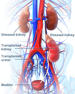 kidney transplant center in Nagpur
